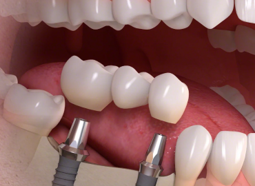 Multiple Dental Implants